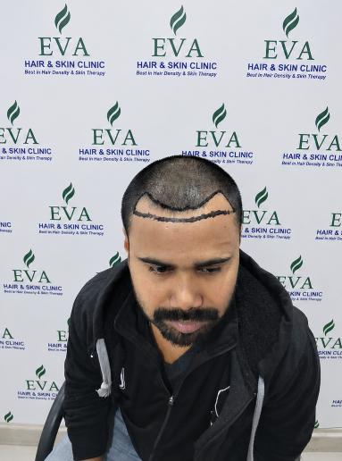 Before hair transplant result 9